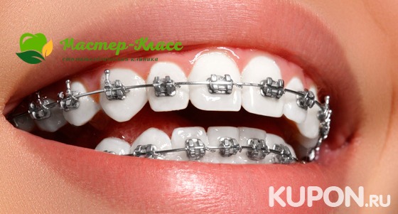 Установка металлических или керамических брекетов в стоматологии «Мастер-класс». Скидка до 79%