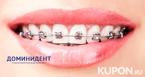 Установка брекет-системы на выбор или ортодонтической съемной пластины в многопрофильной стоматологической клинике «ДоминиДент». Скидка до 80%