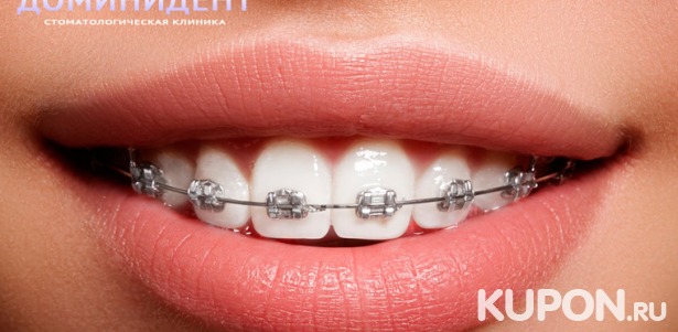 Металлические, керамические или сапфировые брекеты в многопрофильной стоматологической клинике «ДоминиДент». Скидка до 80%