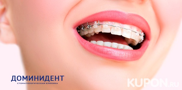 Скидка до 80% на установку ортодонтической съемной пластины или брекетов на выбор в многопрофильной стоматологической клинике «ДоминиДент»