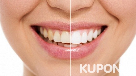 Комплексная гигиена полости рта, чистка зубов и экспресс-отбеливание или установка пломбы в стоматологической клинике «Пять звезд»