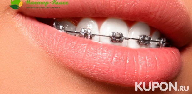 Скидка до 79% на металлические или керамические брекеты в стоматологии «Мастер-класс»