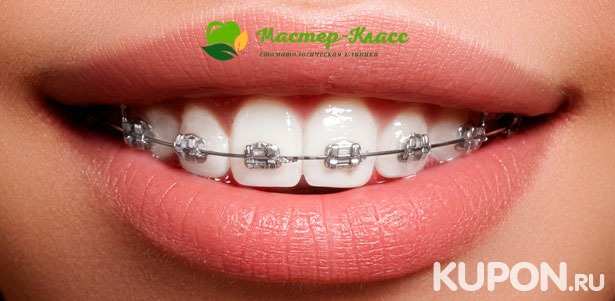 Установка металлических и керамических брекетов, а также имплантация южнокорейскими материалами Dentium в стоматологии «Мастер-класс». Скидка до 79%
