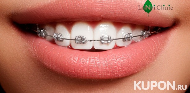 Скидка до 82% на установку металлических и керамических брекет-систем в центре эстетической стоматологии Lanri Clinic