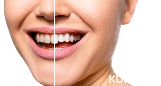 Ультразвуковая чистка зубов для одного или двоих в стоматологии «Стомсервис». Скидка до 60%
