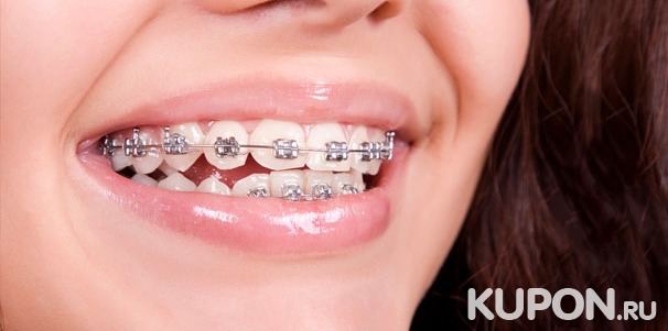 Установка брекет-системы на 1 или 2 челюсти в стоматологии «Далан». Скидка 50%