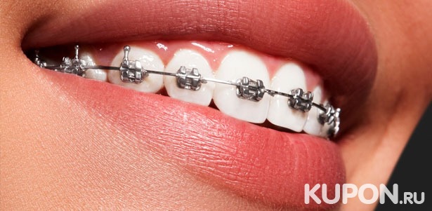 Установка металлической или керамической брекет-системы на 1 или 2 челюсти в стоматологии «Далан». Скидка 50%