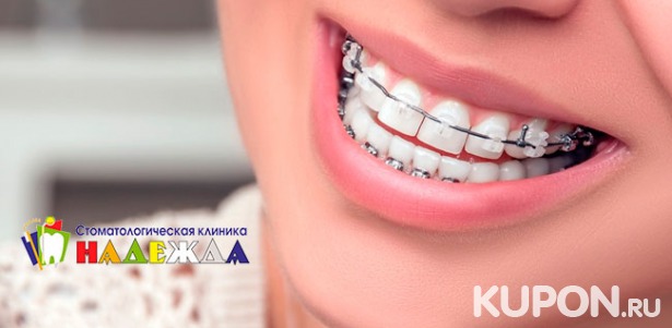 Установка керамических, металлических или комбинированных брекетов в стоматологической клинике «Надежда» со скидкой до 62%