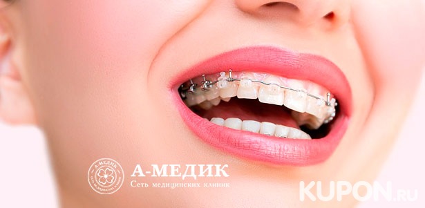 Установка металлических или керамических брекетов на 1 или 2 челюсти в сети многопрофильных клиник «А-медик». Скидка до 81%