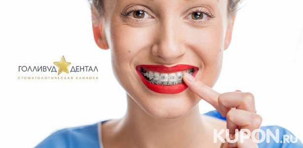 Скидка до 62% на установку сапфировой, металлической или комбинированной брекет-системы в стоматологической клинике «Голливуд Дентал»
