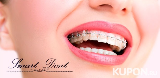 Установка металлических, сапфировых или керамических брекетов на одну или две челюсти в клинике Smart Dent. **Скидка до 77%**