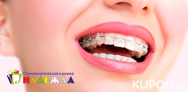Керамические, металлические или комбинированные брекеты в стоматологической клинике «Надежда». **Скидка до 62%**